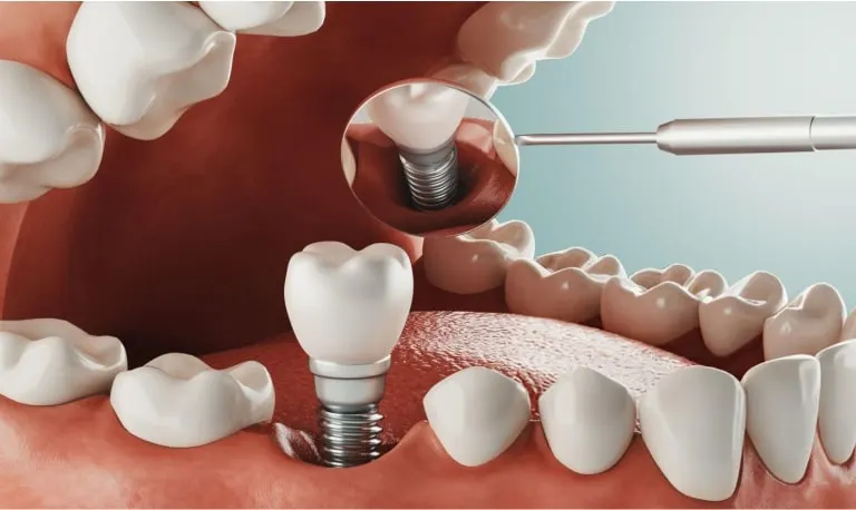 Top 5 Dental Implant Trends Shaping 2025
