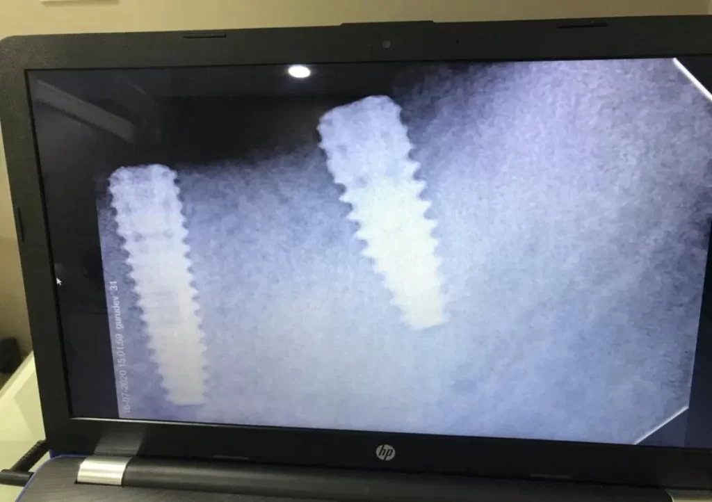 Dental Implant Manufacturer in Mohali