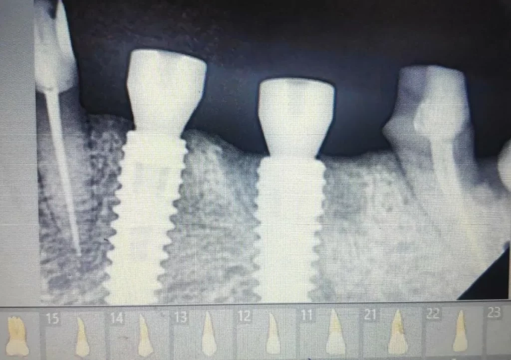 Dental Implants in India