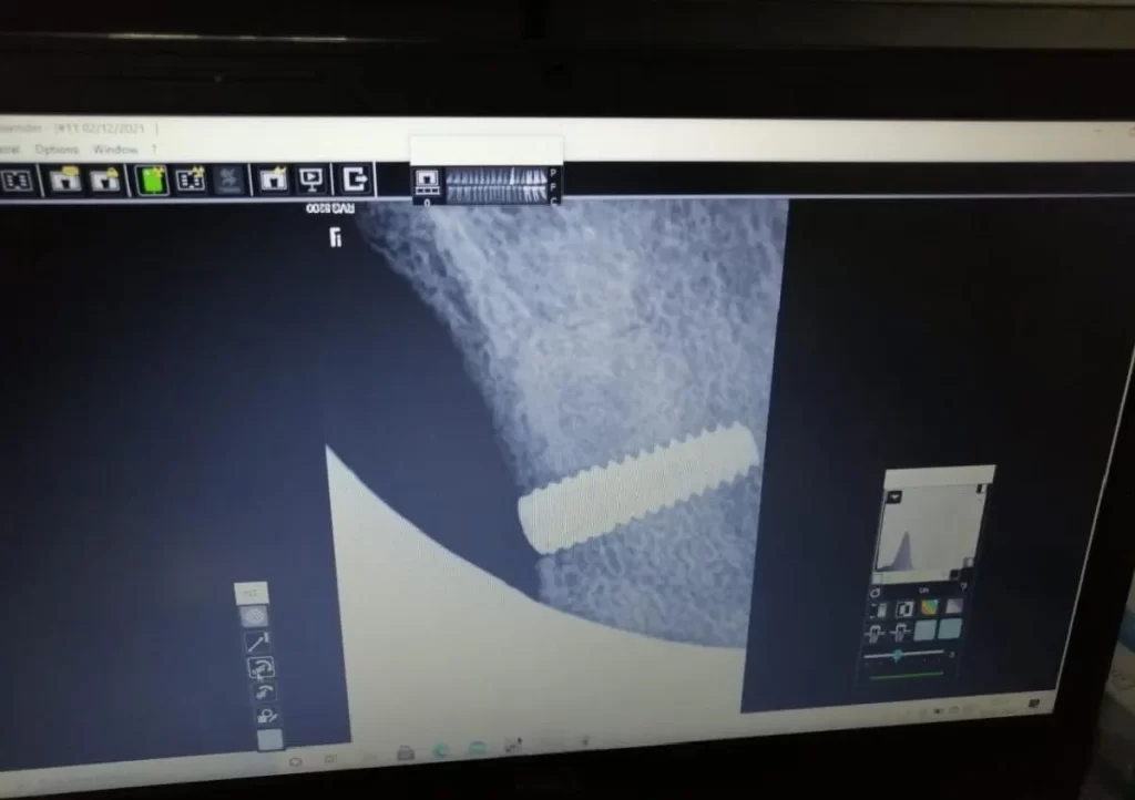 Dental Implant Manufacturer in Mohali