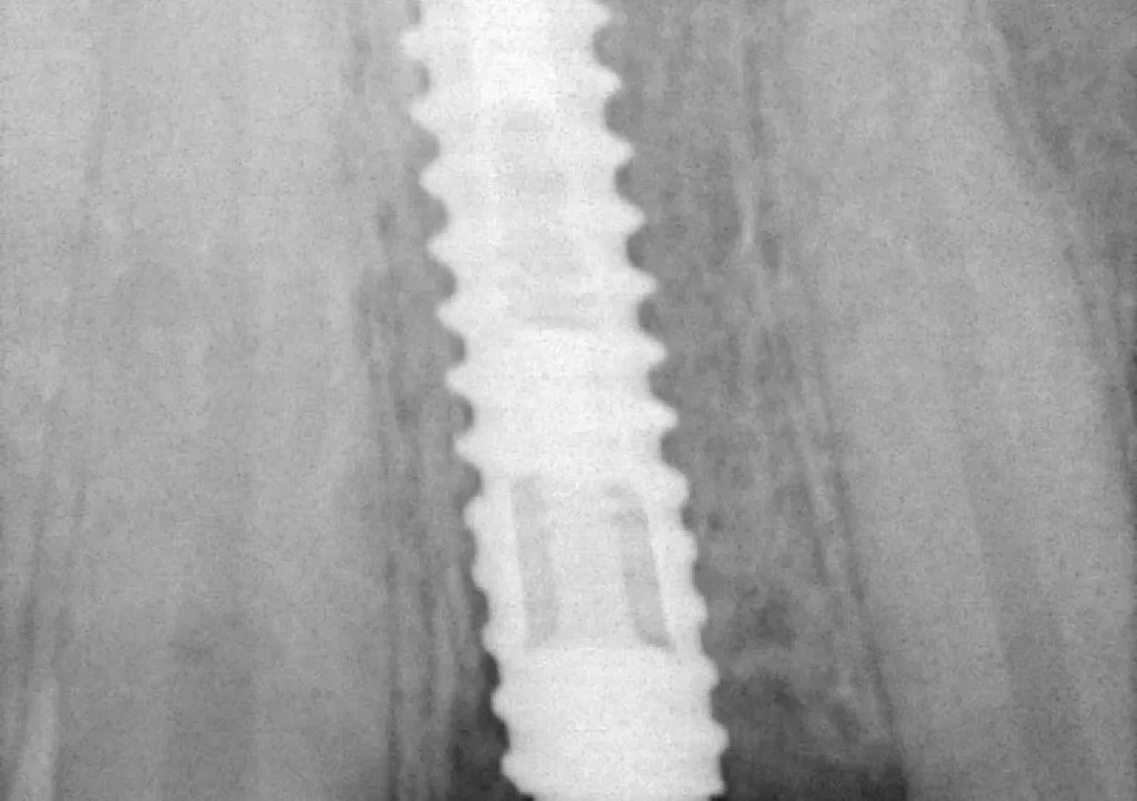 Dental Implant Manufacturer in Punjab