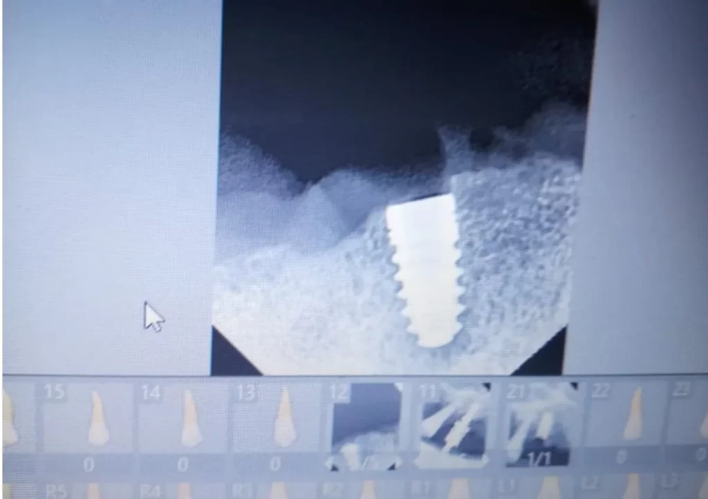 Dental Implants in Chandigarh