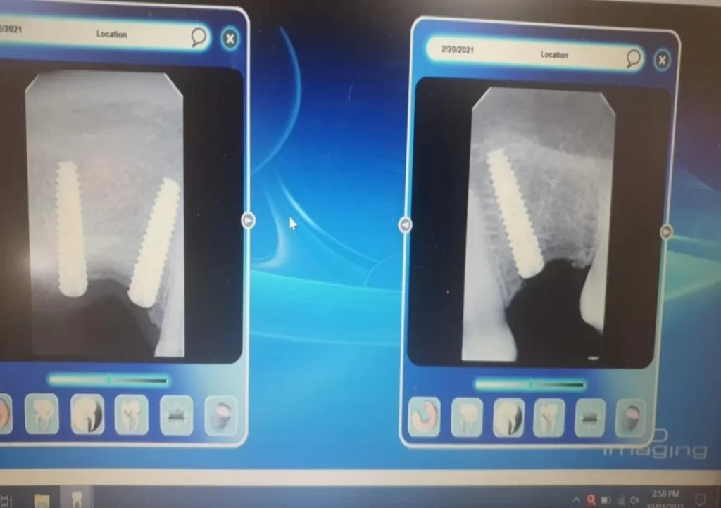 Dental Implant Manufacturer in Punjab