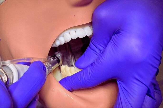 Tooth Implant Manufacturers in India