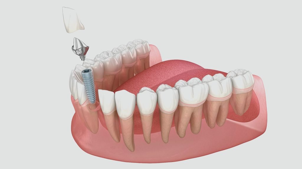 Dental Implants in Chandigarh