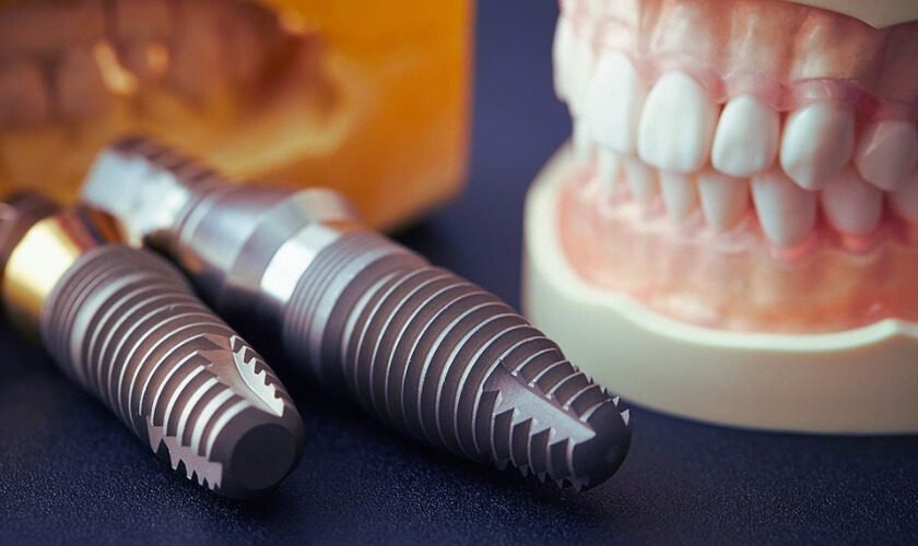 Titanium Implants in India