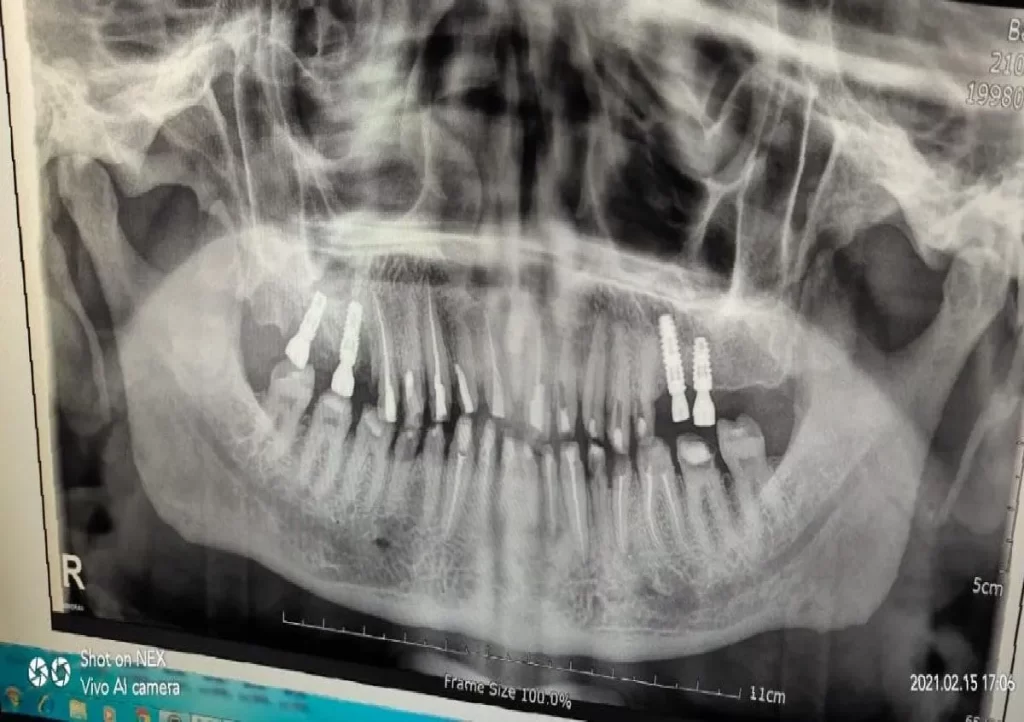 Dental Implant Manufacturer in Chandigarh
