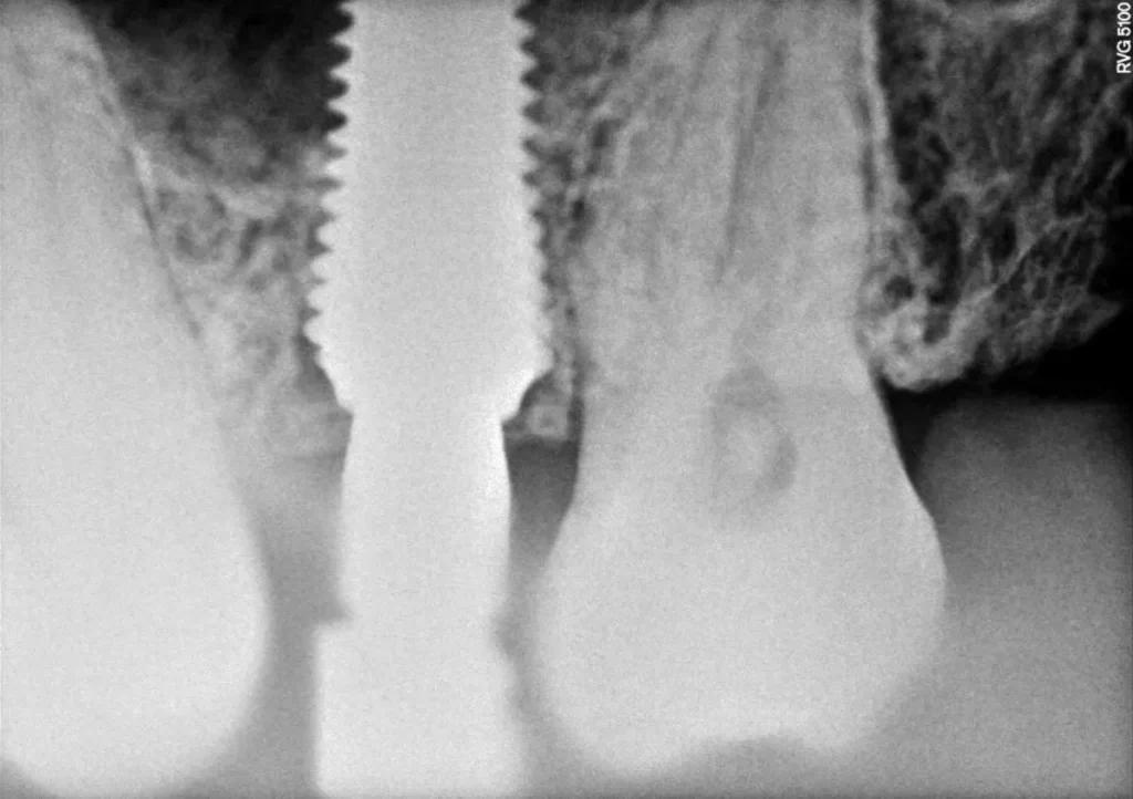 Dental Implants in Chandigarh