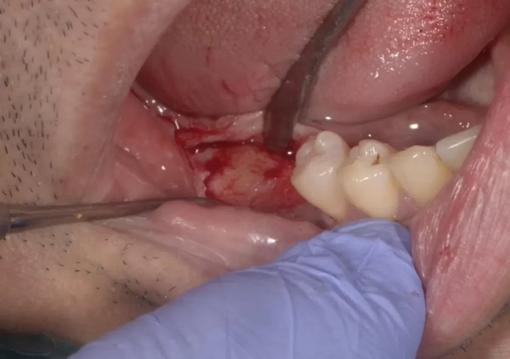 Dental Implant Manufacturer in Mohali