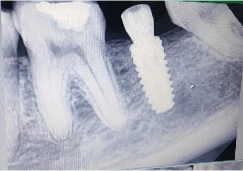 Dental Implants in Chandigarh